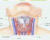 甲状腺癌常识