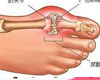 痛风症状