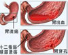 慢性胃溃疡症状