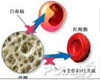 再生障碍性贫血诊断