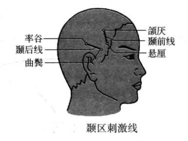 颞区刺激线