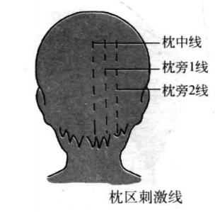 枕区刺激线