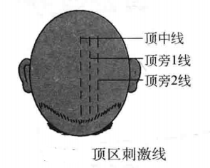 顶区刺激线